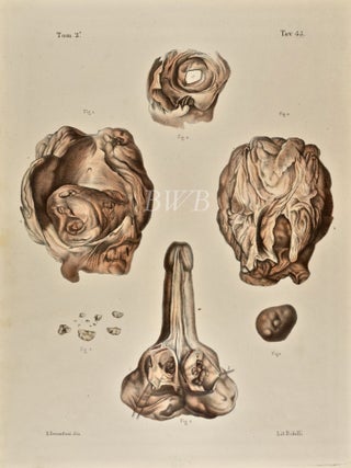 Item #618865 Calcoli incastrata nella sostanza della vessica, e della prostata [Stones embedded...