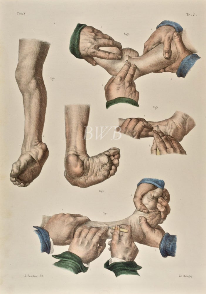 Item #618867 Operazioni sul piè tondo [Operations for round foot or clubfoot, 1]. Nicolas Henri Jacob, J. M. Bourgery.